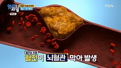 치매 유발하는 혈전, 제거해주는 음식 (+먹는법,부작용)