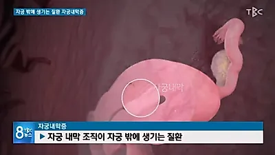 에스트로겐 수치 낮추면 자궁내막증 예방 가능하다?