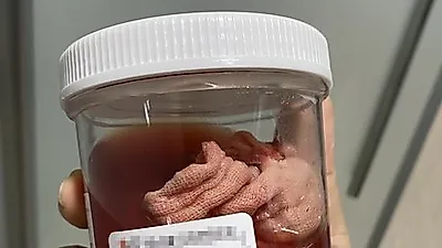 몸속에 거즈 남아있던 산모에게
