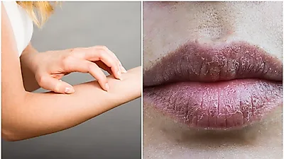 "간지러워" 건조해진 피부 되돌리는 방법