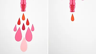 생리 불규칙 야기하는 ‘다낭성난소증후군’, 증상 및 예방법