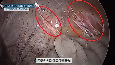 가임기 여성의 15%가 자궁내막증으로 고생한다