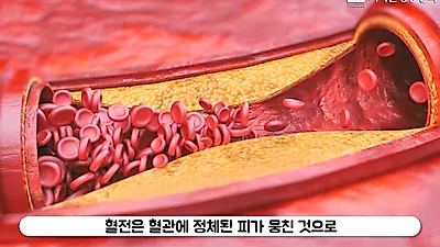 피임약 먹는 사람은 혈전 걸리기가 쉽다?