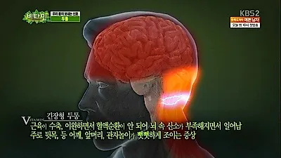 한 쪽만 아픈 편두통, 심할 때 "구토 동반" (+두통에 좋은 음식)