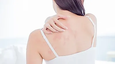 루푸스병, 여성 발생률이 높은 이유와 예방에 좋은 음식(+증상, 효능)