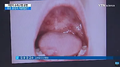 입안에도 물집이? 우리 아이 괴롭히는 수족구병의 모든 것