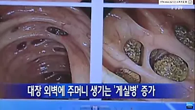 대장벽에 주머니가? 대장게실염 증상 및 치료법