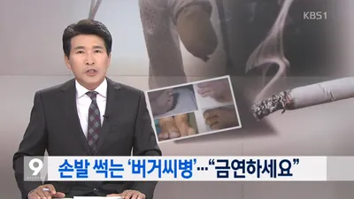 결국엔 사지 절단? 젊은 남자들의 적, 버거씨병