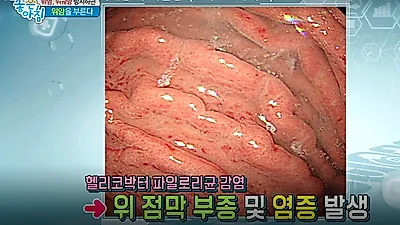 천공이 생기는 위궤양, "뚜렷한 초기 증상 없어"(+위궤양에 좋은 음식과 예방법)